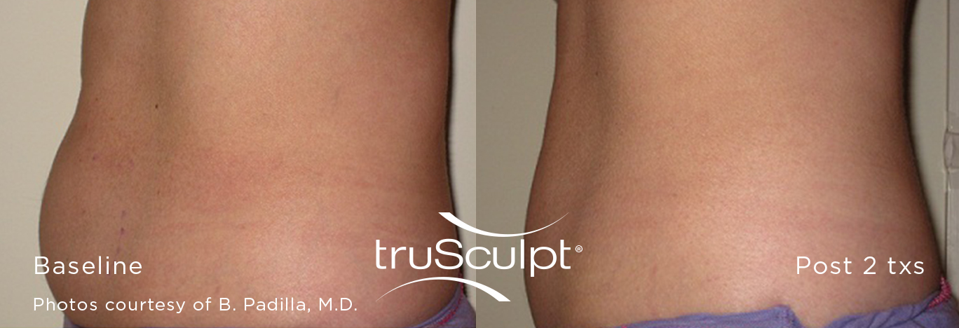 truSculpt_Body_6